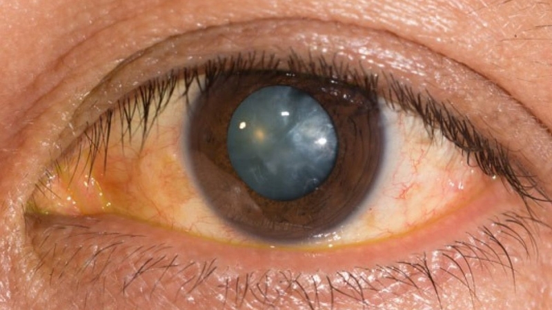 TẬT MẮT NHỎ 5.jpg