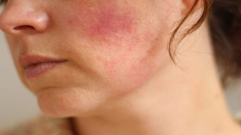 Tác dụng phụ Retinol và cách khắc phục bạn cần tìm hiểu rõ trước sử dụng 2