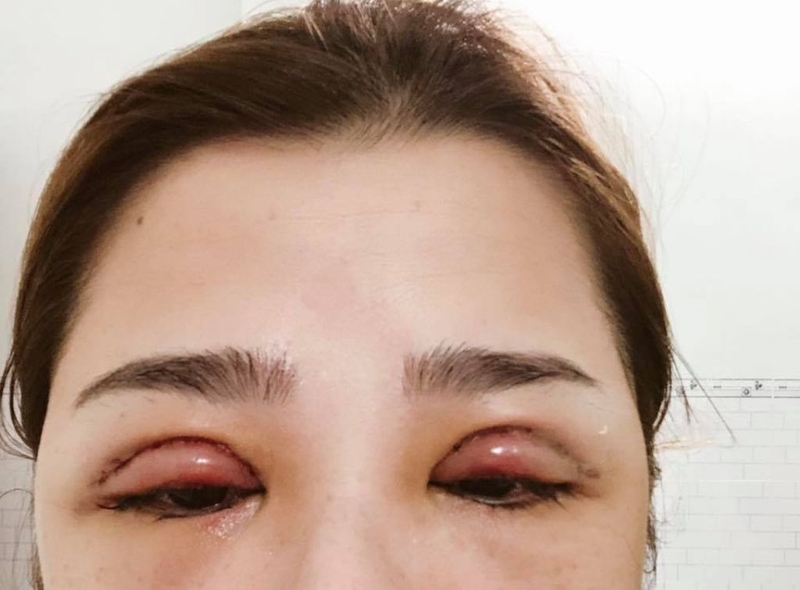 Tác hại của cắt mí mắt và những điều mà chị em thích làm đẹp cần phải biết 2