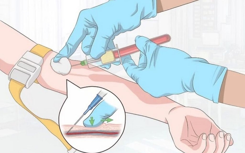 Tai biến khi tiêm tĩnh mạch là gì? Nguyên nhân và phương pháp xử lý 3