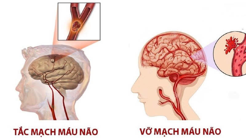 Tai biến mạch máu não có mấy thể? Dấu hiệu nhận biết cơn đột quỵ não mà bạn nên biết2