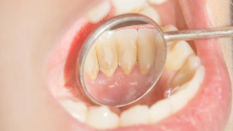Tại sao nhiều nha sĩ luôn khuyến khích phải lấy cao răng định kỳ 3