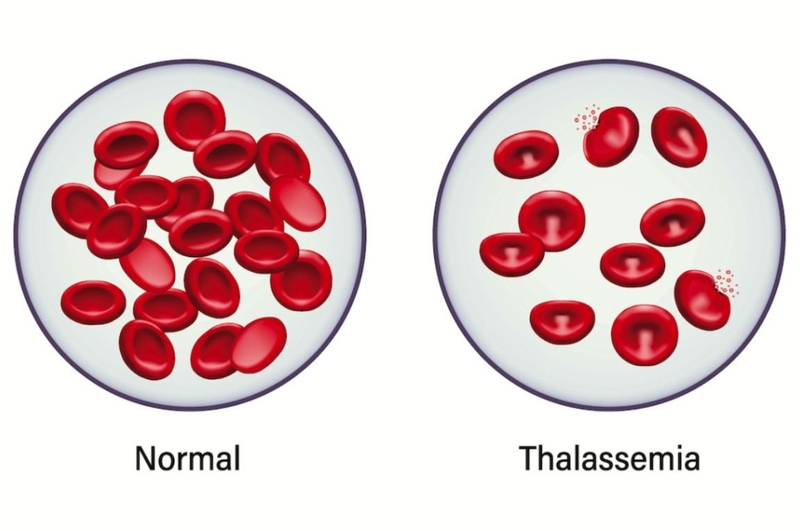 Tan máu bẩm sinh là gì? Dấu hiệu bệnh tan máu bẩm sinh ở trẻ em 1