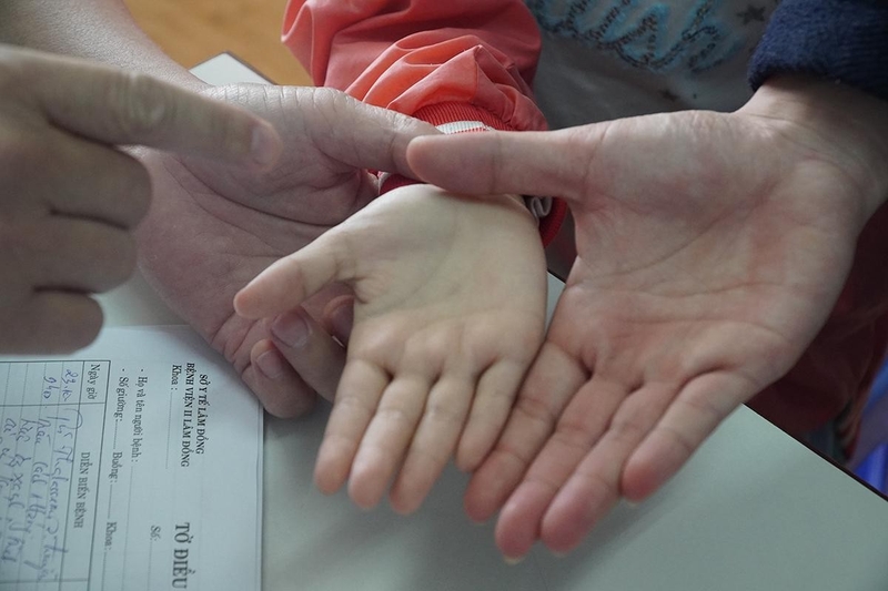 Tan máu bẩm sinh là gì? Dấu hiệu bệnh tan máu bẩm sinh ở trẻ em 2