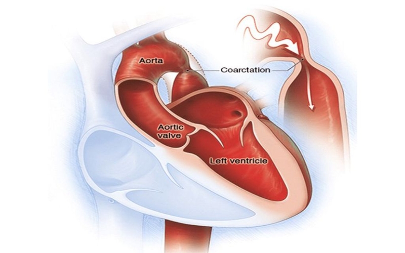 Tăng gánh thất trái là gì? Nguyên nhân và phương pháp điều trị hiệu quả 1