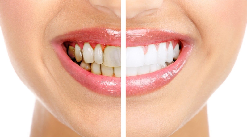 Dán veneer được bao lâu? Yếu tố ảnh hưởng đến tuổi thọ của mặt dán sứ? 2