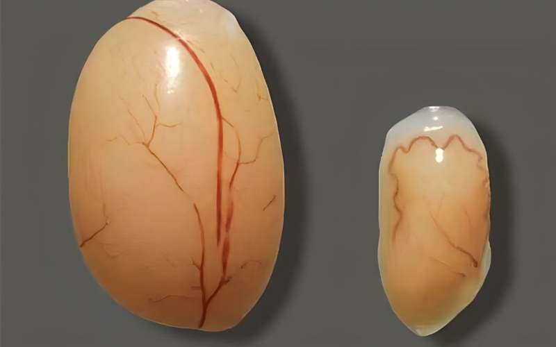 Teo tinh hoàn có chữa được không? Nguyên nhân và cách điều trị 1