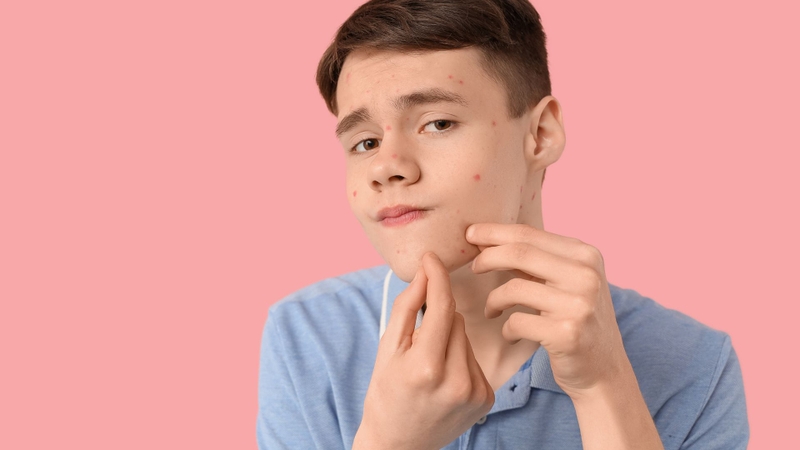 Mọc nhiều mụn trứng cá là một trong những tác dụng phụ của Testosterone cypionate