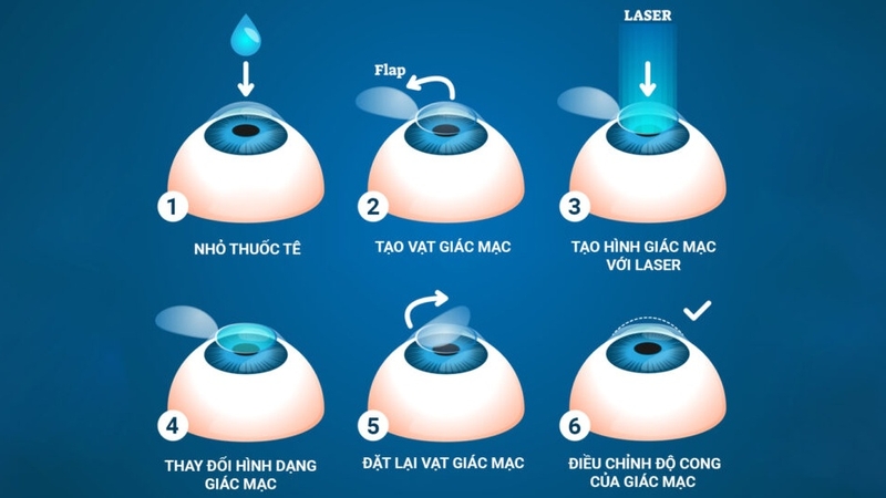 Lasik Surgery là gì? Một số đối tượng có thể thực hiện phẫu thuật mắt Lasik? 04