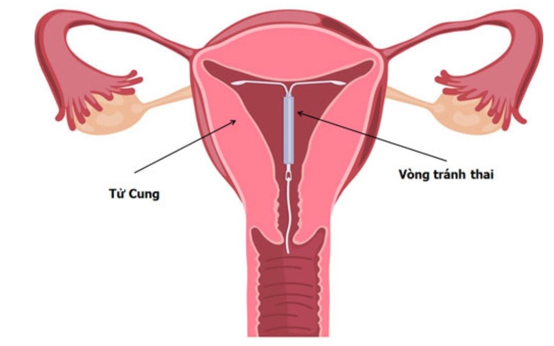 Tháo vòng tránh thai có đau không? Biến chứng xảy ra sau khi tháo vòng 1