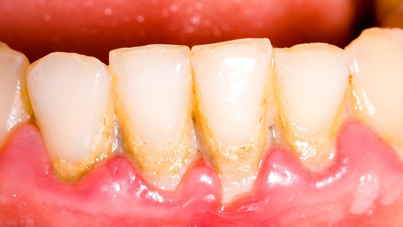 Thế nào là cao răng độ 2? Mức độ ảnh hưởng răng miệng ra sao 1