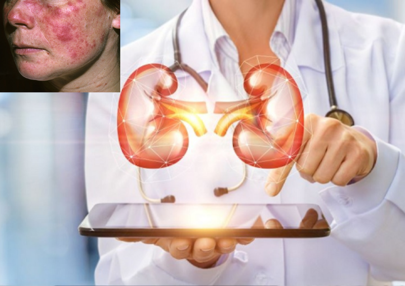 Xét nghiệm lupus ban đỏ ở đâu chính xác và an toàn? 3