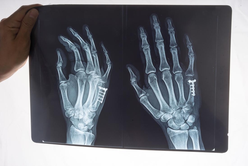 Thời gian điều trị bong gân cổ tay bao lâu thì khỏi 2