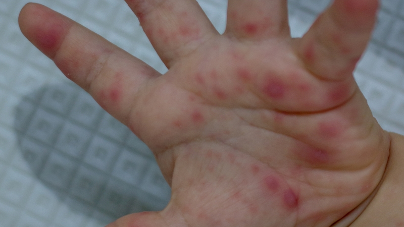 Thời gian ủ bệnh tay chân miệng là bao lâu? Cách phòng ngừa tay chân miệng 3