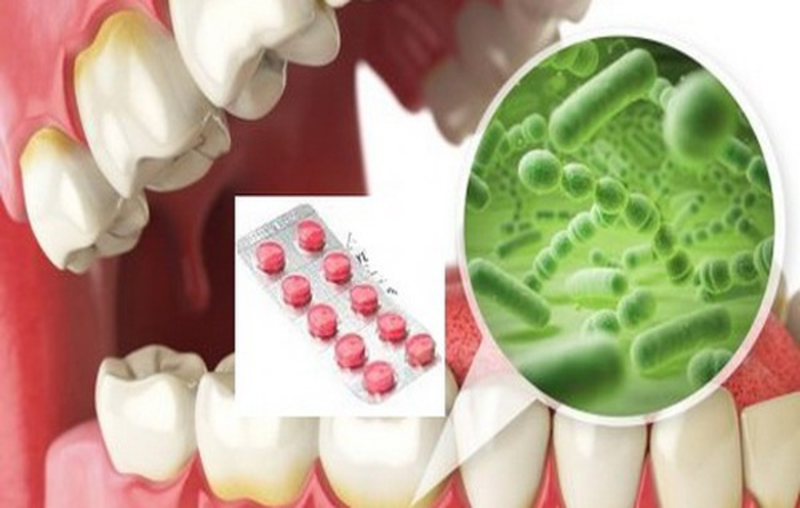 Thuốc kháng sinh điều trị viêm tuỷ răng 3.png