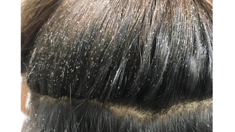 Thuốc nhuộm tóc có thể loại bỏ chấy nhưng không loại bỏ được trứng chấy 1