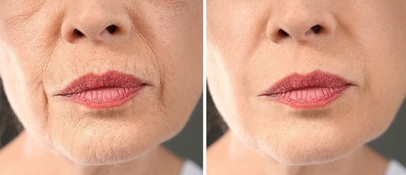 Tiêm meso có an toàn không? Khi nào thì nên sử dụng phương pháp thẩm mỹ tiêm meso? 2