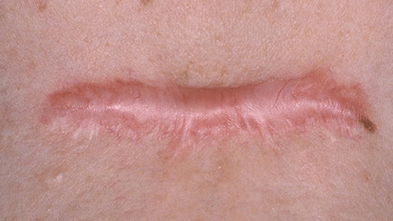 Tiêm sẹo lồi giá bao nhiêu? 1