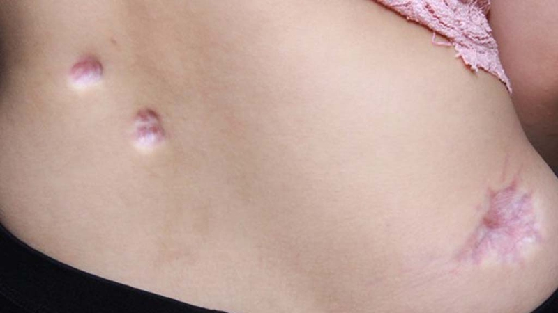 Tiêm sẹo lồi giá bao nhiêu? 4