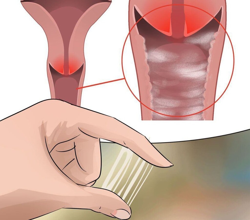 Tiền ung thư cổ tử cung: Nguyên nhân, triệu chứng, các phương pháp chẩn đoán và điều trị 3