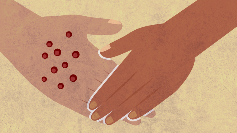 Tiếp xúc trực tiếp với các vết phát ban có thể khiến bạn bị nhiễm bệnh 2