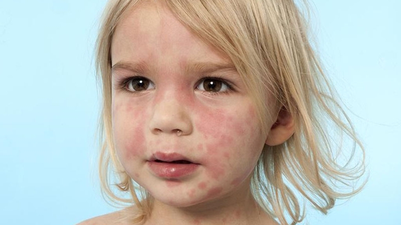 Nguyên nhân dẫn đến dị ứng có thể là phấn hoa, nấm mốc, lông chó mèo, di truyền,...1