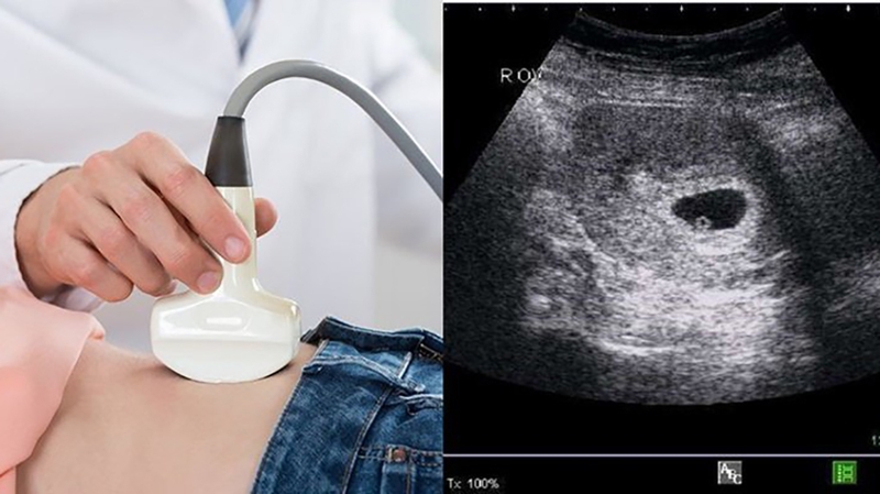 Túi trống âm có phải là túi thai không 1