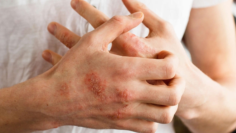 Tìm hiểu về tình trạng dị ứng latex 1