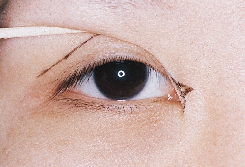 Tình trạng nếp mí rẻ quạt là như thế nào? Cách khắc phục ra sao 1