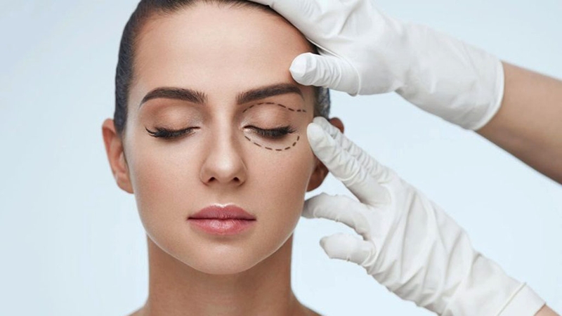 Tình trạng nếp mí rẻ quạt là như thế nào? Cách khắc phục ra sao 2