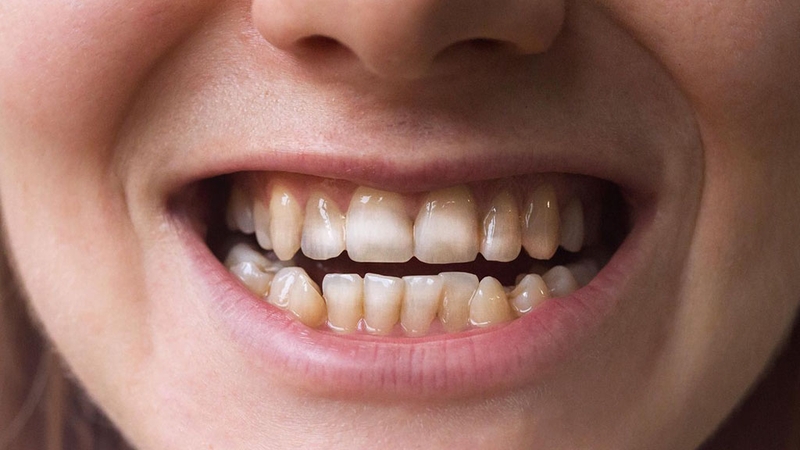 Tình trạng sâu răng nhẹ là giai đoạn đầu cấp độ 1