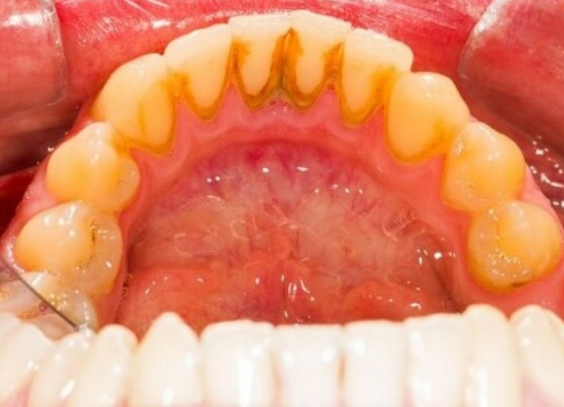 Tình trạng sưng nướu răng và nổi hạch cảnh báo bệnh gì? 5