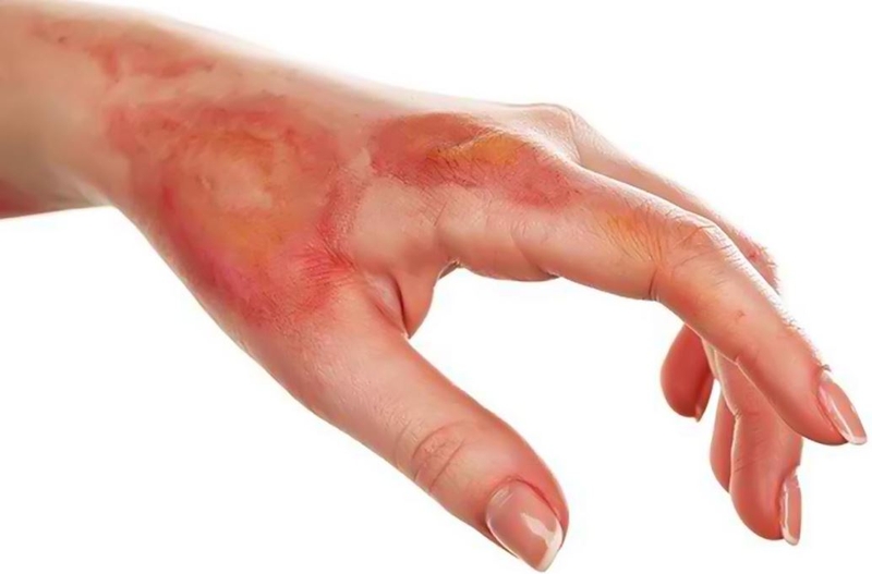 Tổ đỉa dị ứng: Nguyên nhân và xử trí 2