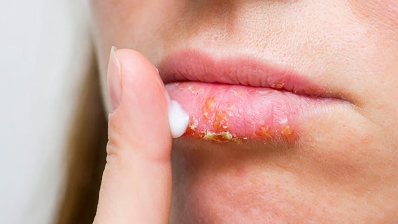 Tổng hợp các nguyên nhân phổ biến gây viêm môi cơ địa 2