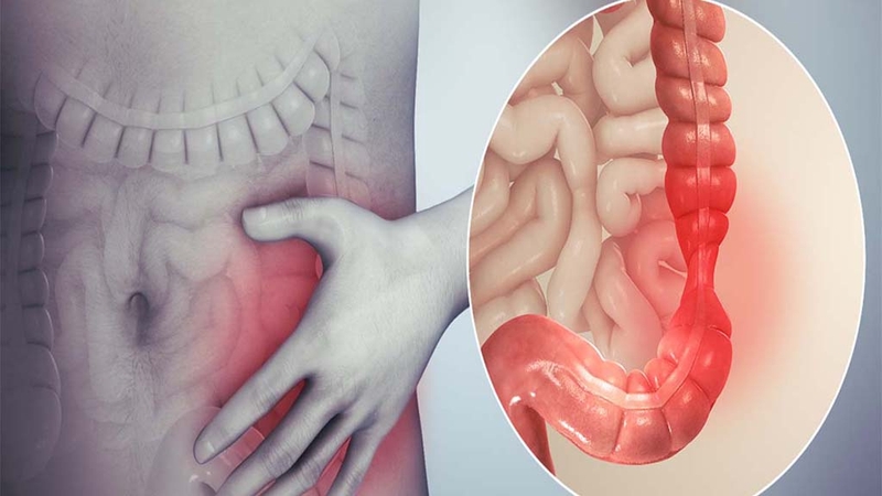 Tổng hợp các thông tin về viêm loét đại tràng 2