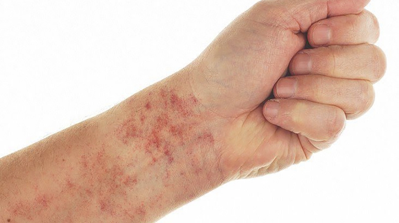 Tổng quan các thông tin cần biết về xuất huyết giảm tiểu cầu vô căn 2