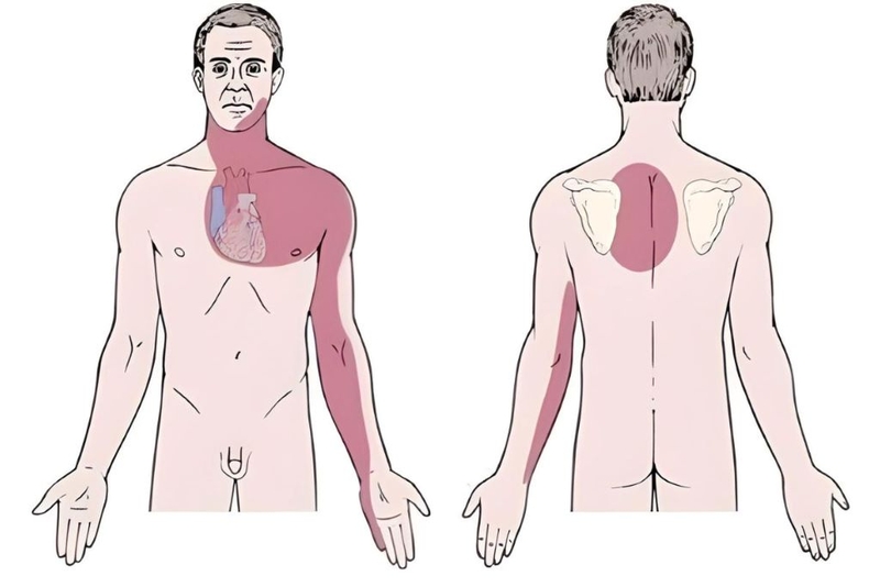 Tổng quan và các phương pháp điều trị hội chứng vành mạn 2