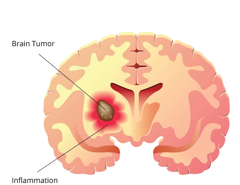 Tổng quan về chẩn đoán, giai đoạn và phân độ bệnh của u sao bào ở trẻ em 2