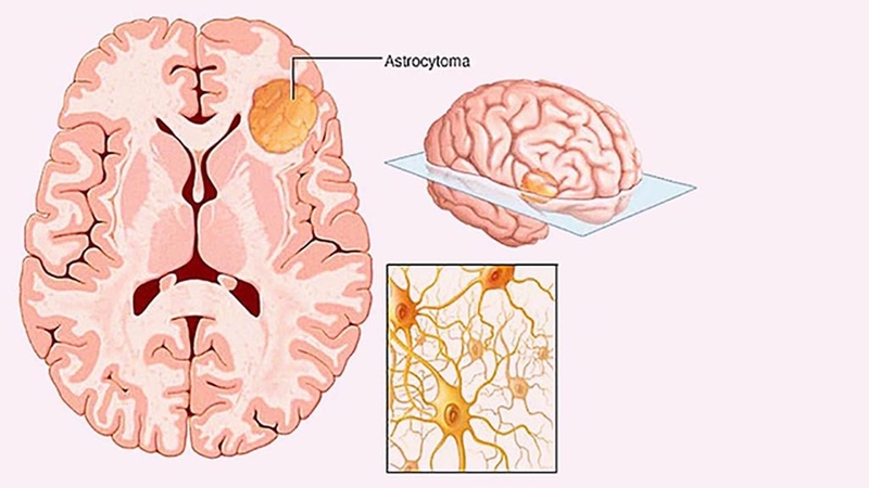 Tổng quan về chẩn đoán, giai đoạn và phân độ bệnh của u sao bào ở trẻ em 3