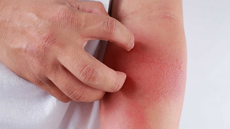 Tìm hiểu về tình trạng dị ứng latex 2