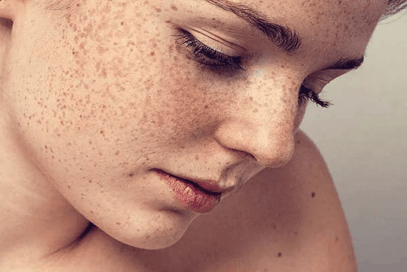 Top 3 kem trị đồi mồi Hàn Quốc hiệu quả nhất 1