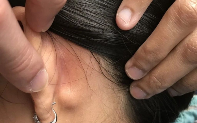 Trẻ 10 tháng tuổi bị nổi hạch sau tai có nguy hiểm không? Nguyên nhân do đâu 2