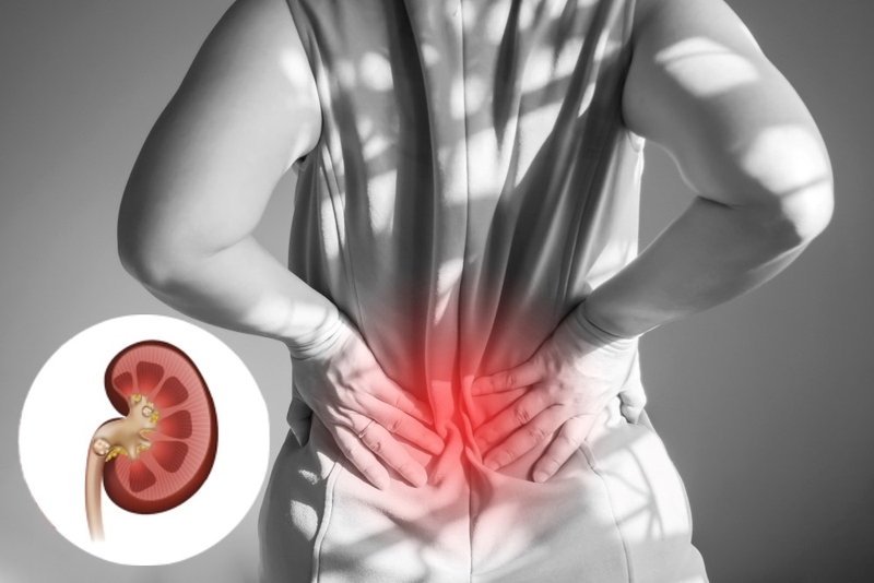 Triệu chứng sỏi tiết niệu 02