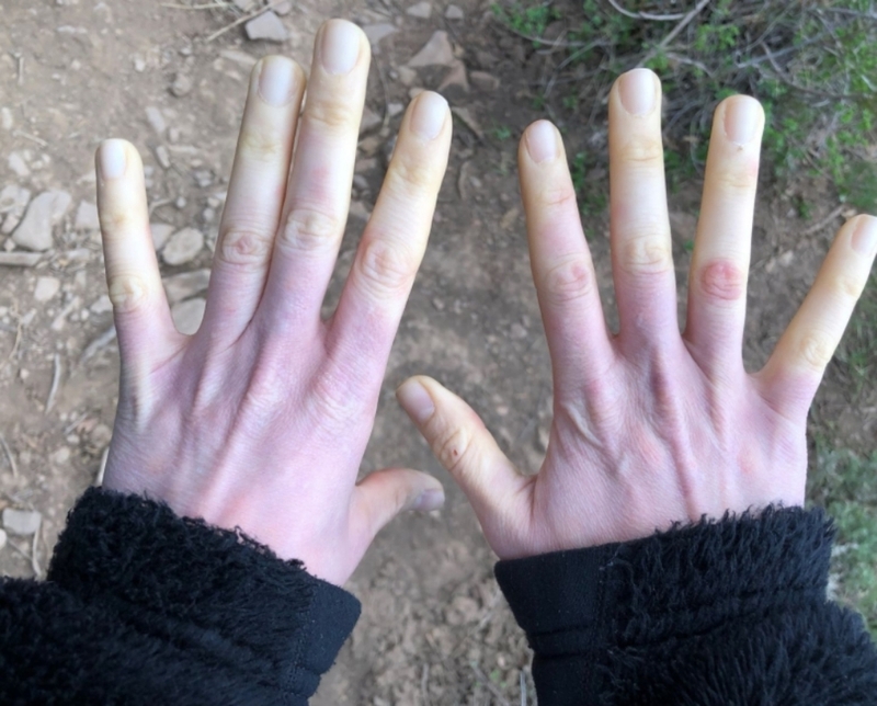 Triệu chứng và dấu hiệu lâm sàng chẩn đoán hội chứng Raynaud 1