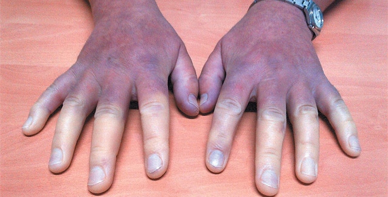 Triệu chứng và dấu hiệu lâm sàng chẩn đoán hội chứng Raynaud 3