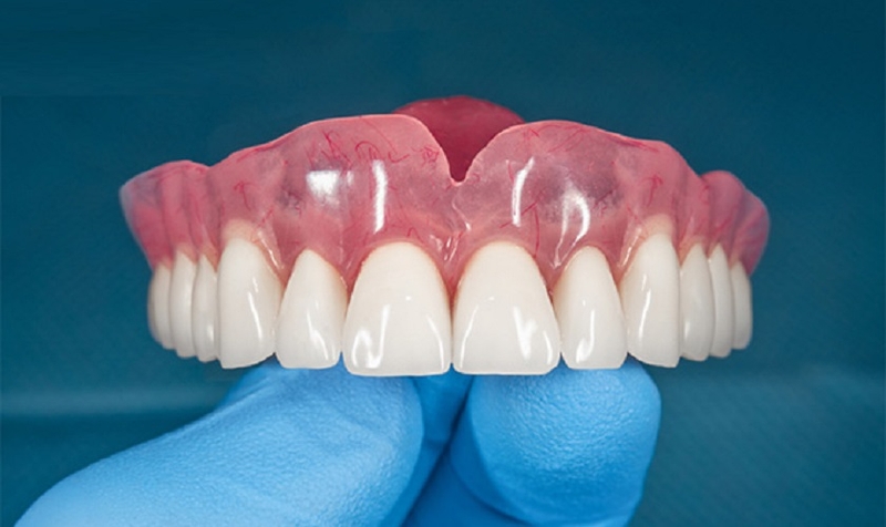 Trồng răng cấm giá bao nhiêu? Nên chọn phương pháp nào? 2