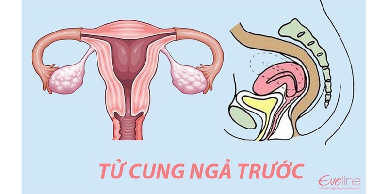 Tử cung ngả trước 1