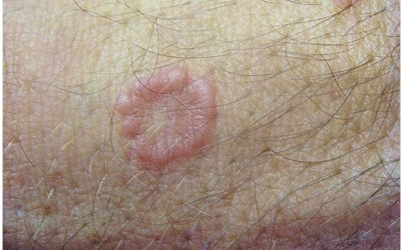 U hạt vòng có nguy hiểm không? Nguyên nhân và phương pháp điều trị 1