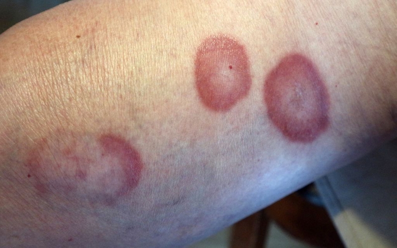 U hạt vòng có nguy hiểm không? Nguyên nhân và phương pháp điều trị 2