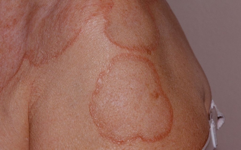 U hạt vòng có nguy hiểm không? Nguyên nhân và phương pháp điều trị 3